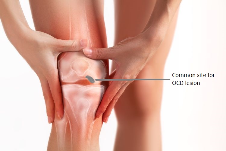 ACL Reconstruction surgery