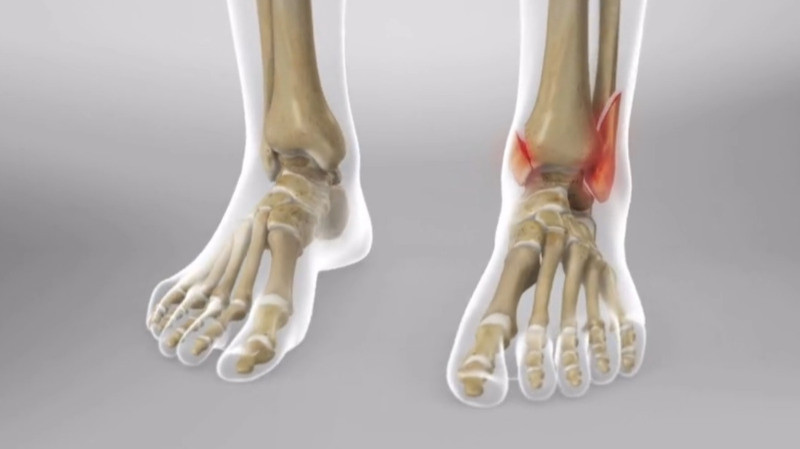 ACL Reconstruction surgery