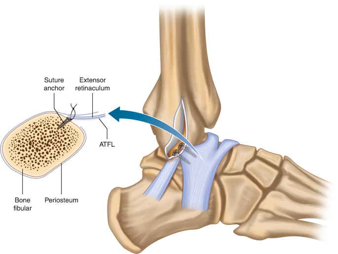 ACL Reconstruction surgery