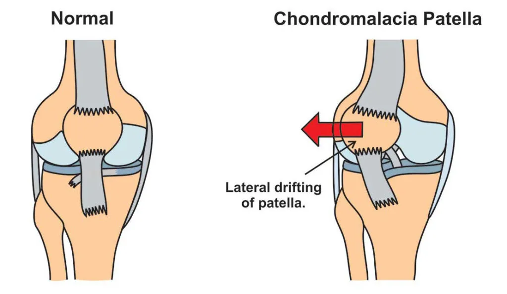 ACL Reconstruction surgery