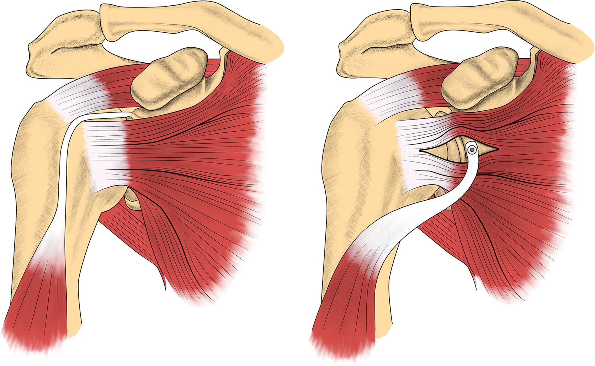 ACL Reconstruction surgery