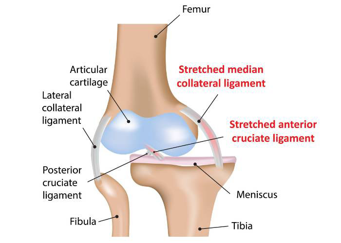 ACL Reconstruction surgery