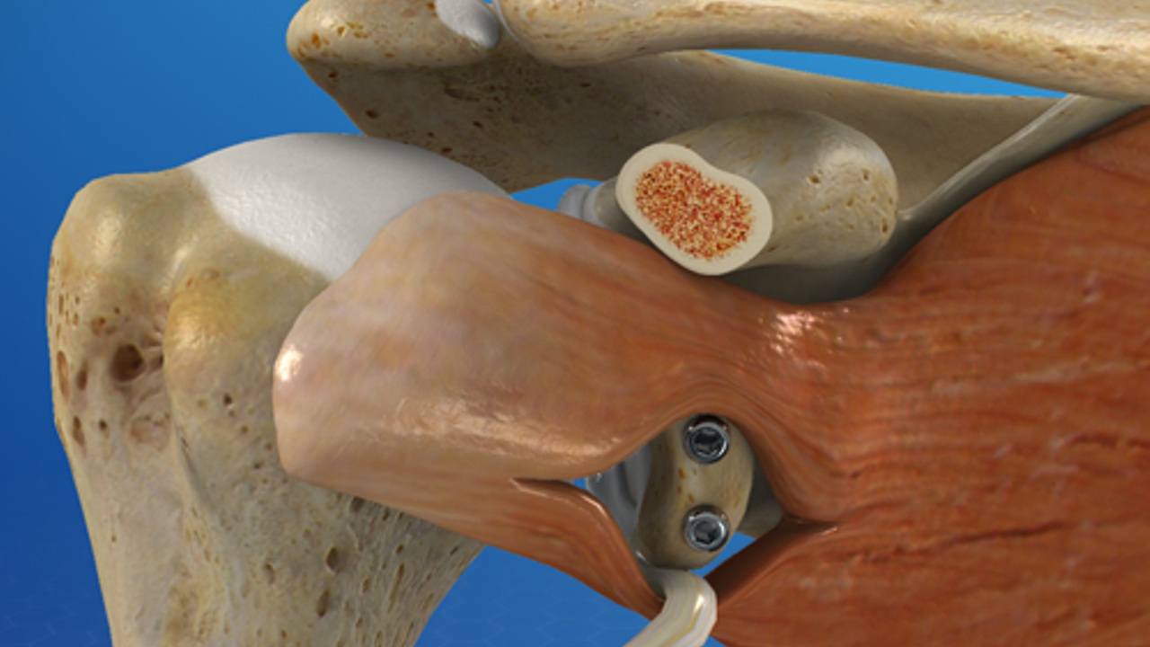 ACL Reconstruction surgery