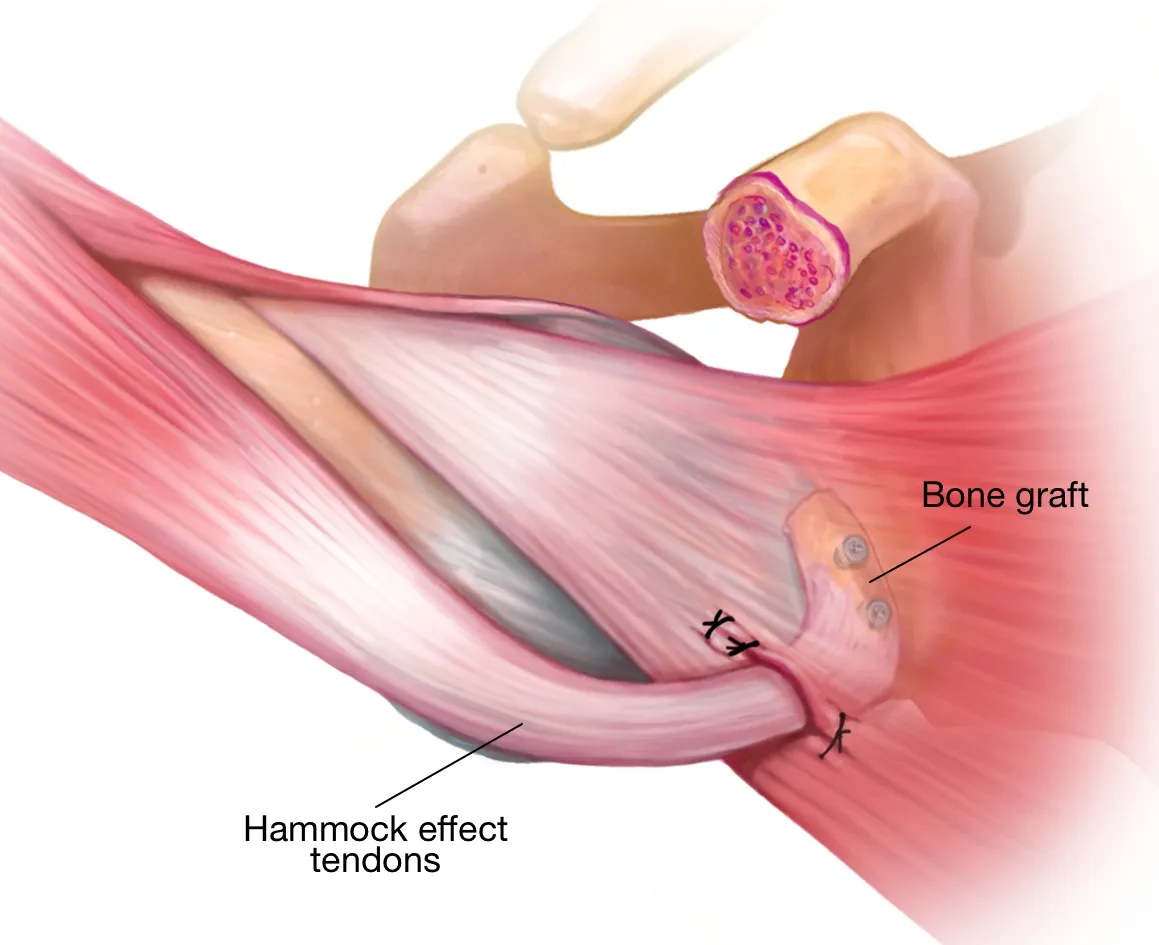 ACL Reconstruction surgery