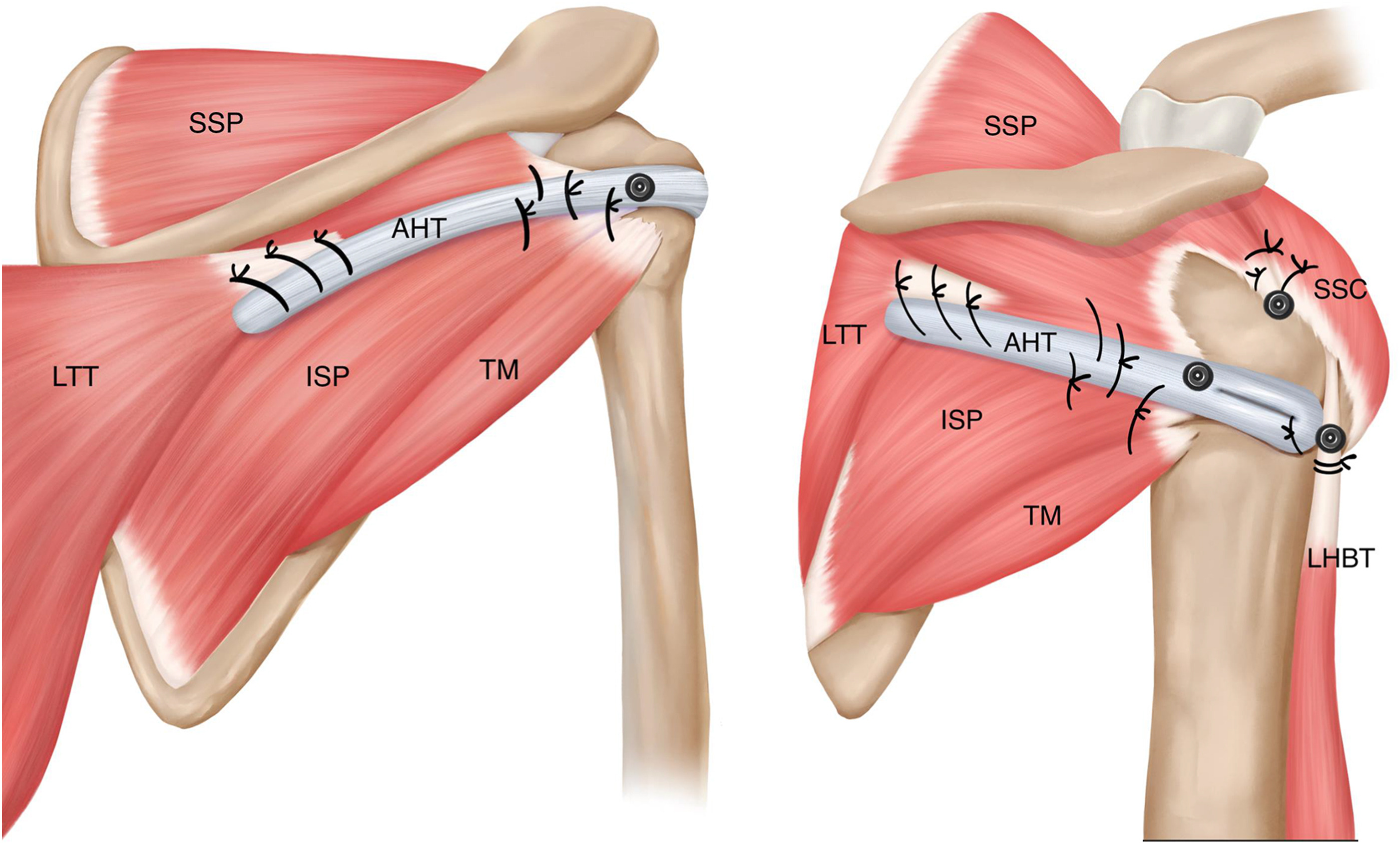 ACL Reconstruction surgery