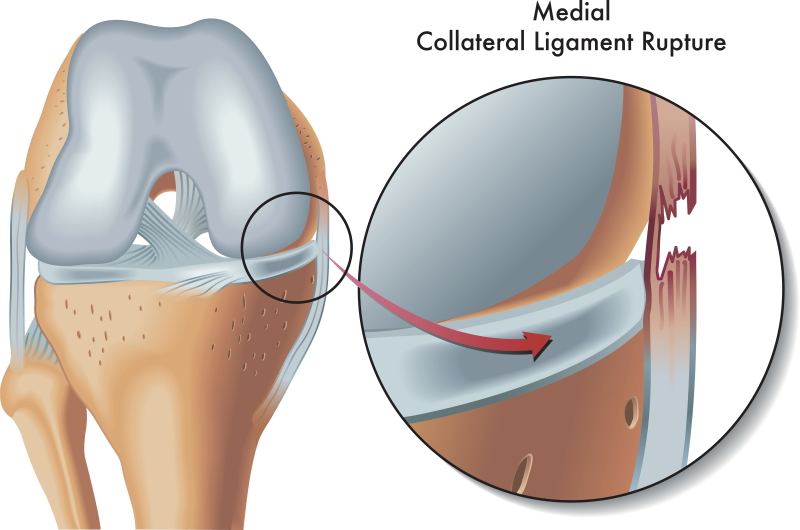 ACL Reconstruction surgery