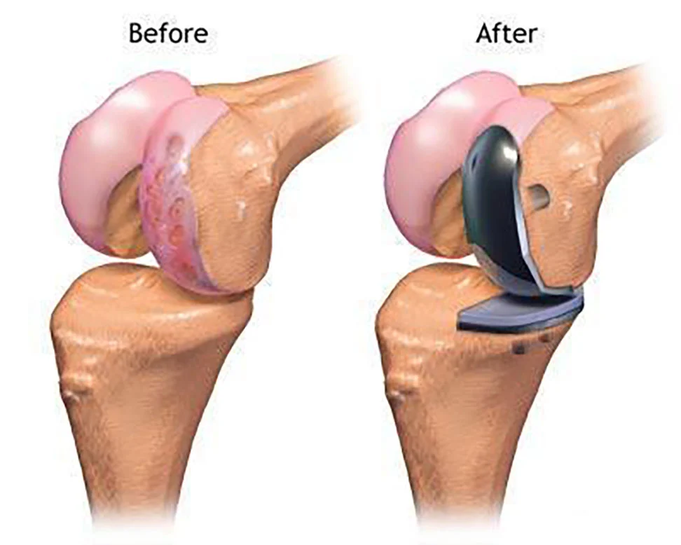 ACL Reconstruction surgery