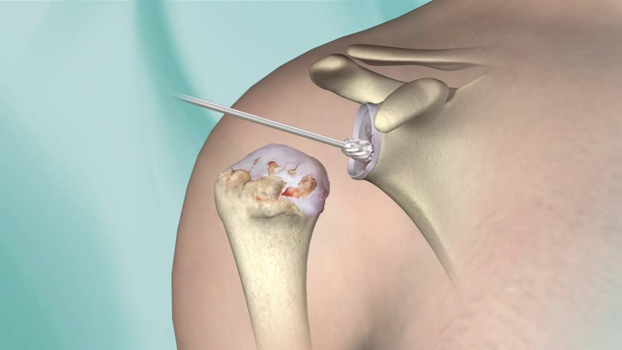 ACL Reconstruction surgery