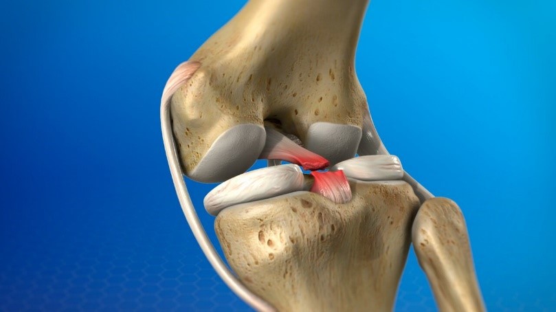 ACL Reconstruction surgery