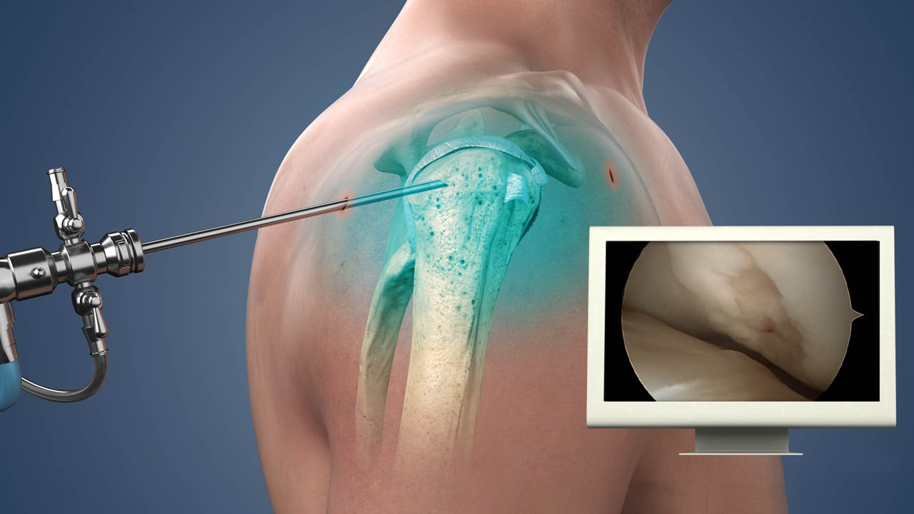 ACL Reconstruction surgery